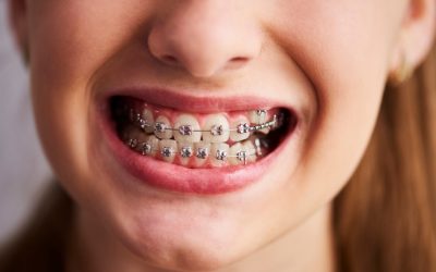 CONSEJOS PARA UNA BUENA HIGIENE PARA LAS  BOCAS CON BRACKETS